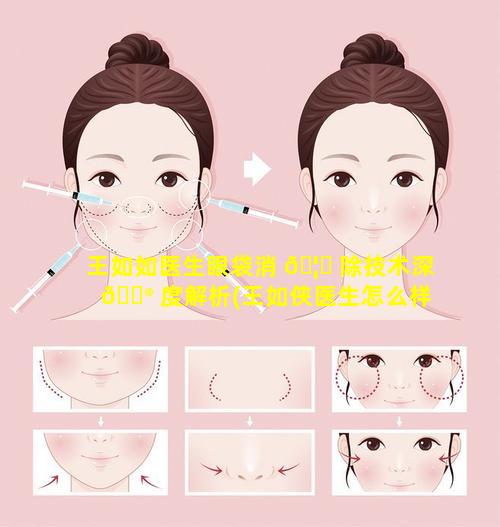 王如如医生眼袋消 🦊 除技术深 💮 度解析(王如侠医生怎么样)